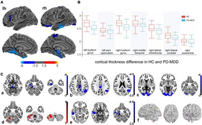 Abnormal cortical atrophy and functional connectivity are associated with depression in Parkinson’s disease